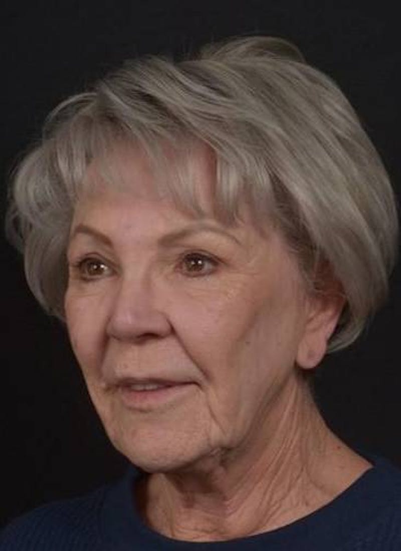Facelift Before & After Gallery - Patient 101724 - Image 3