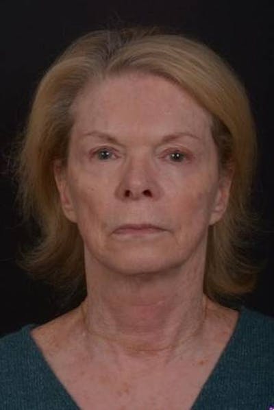 Facelift Before & After Gallery - Patient 159447 - Image 1