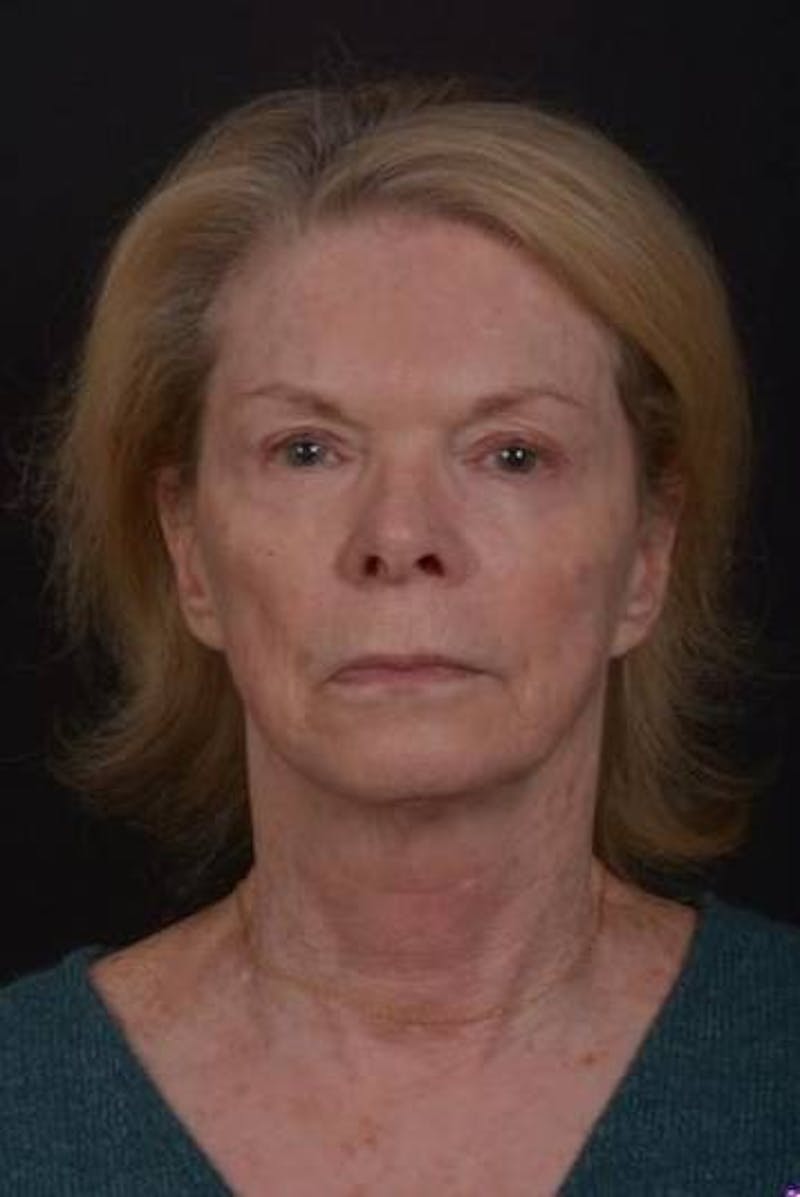 Facelift Before & After Gallery - Patient 159447 - Image 1