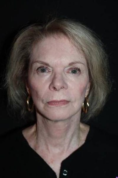 Facelift Before & After Gallery - Patient 159447 - Image 2