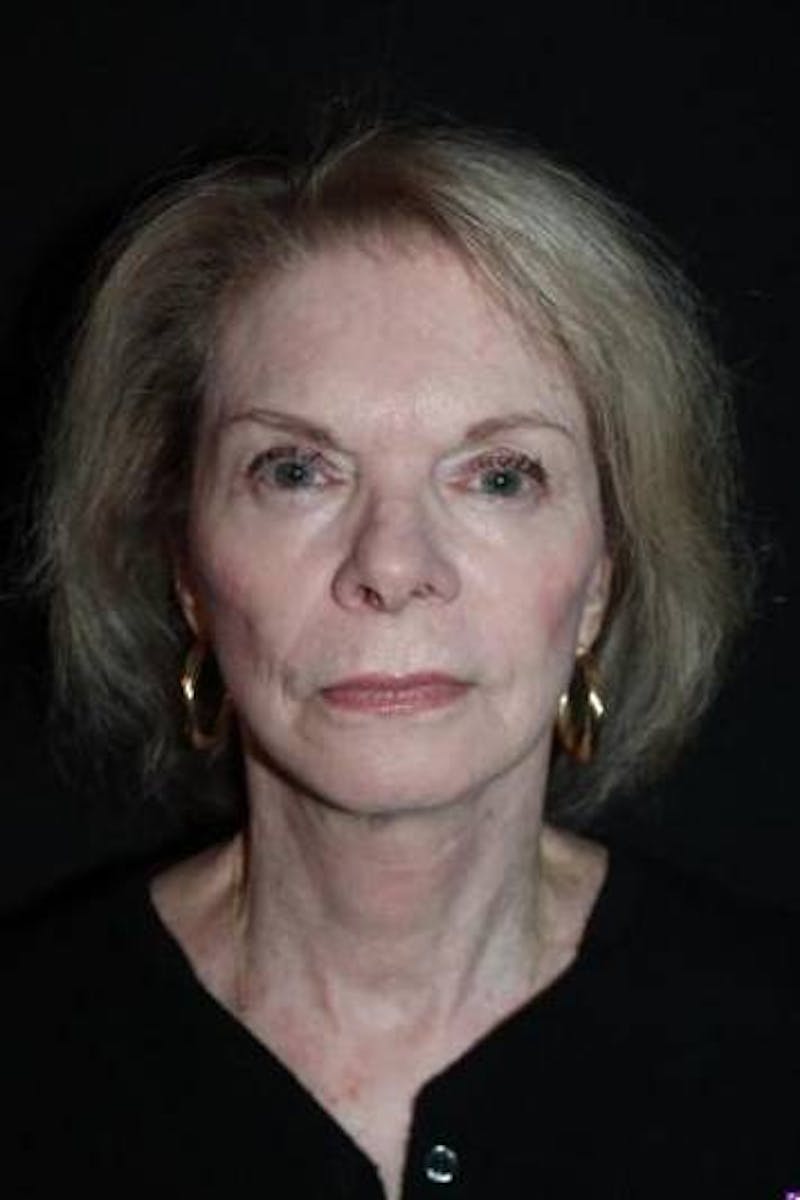 Facelift Before & After Gallery - Patient 159447 - Image 2