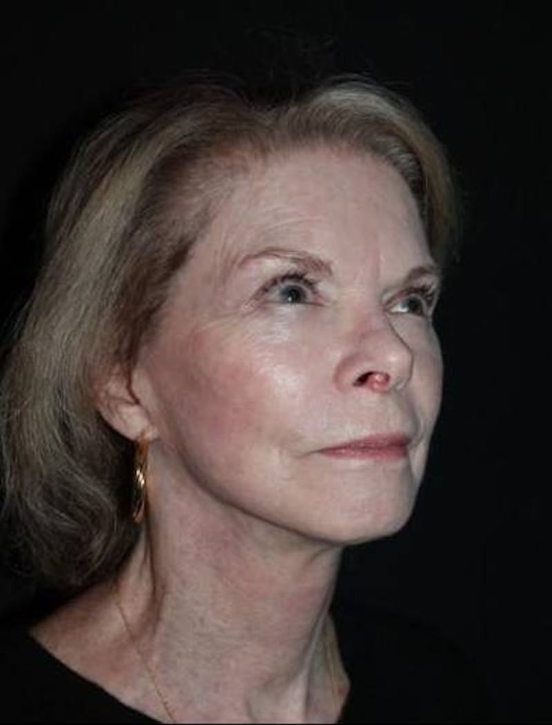 Facelift Before & After Gallery - Patient 159447 - Image 8
