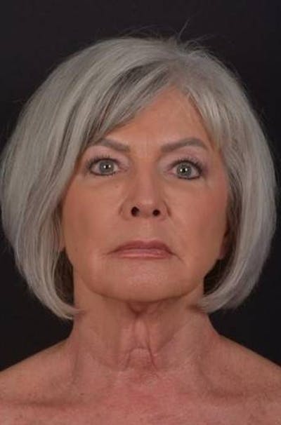 Facelift Before & After Gallery - Patient 152126 - Image 1