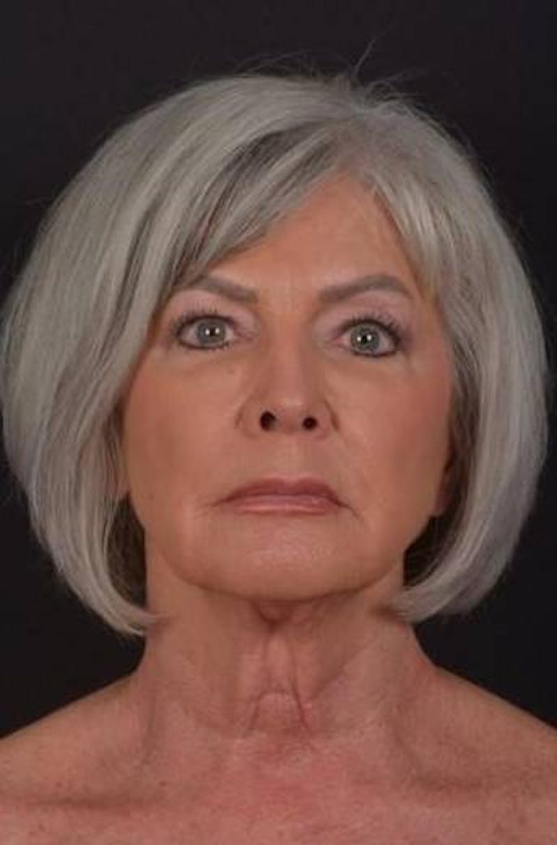 Facelift Before & After Gallery - Patient 152126 - Image 1