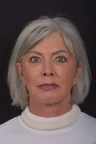 Facelift Before & After Gallery - Patient 152126 - Image 2