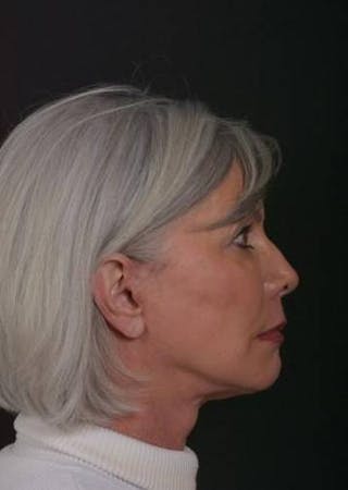 Facelift Before & After Gallery - Patient 152126 - Image 10