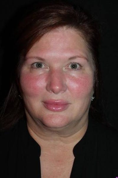 Facelift Before & After Gallery - Patient 165652 - Image 1