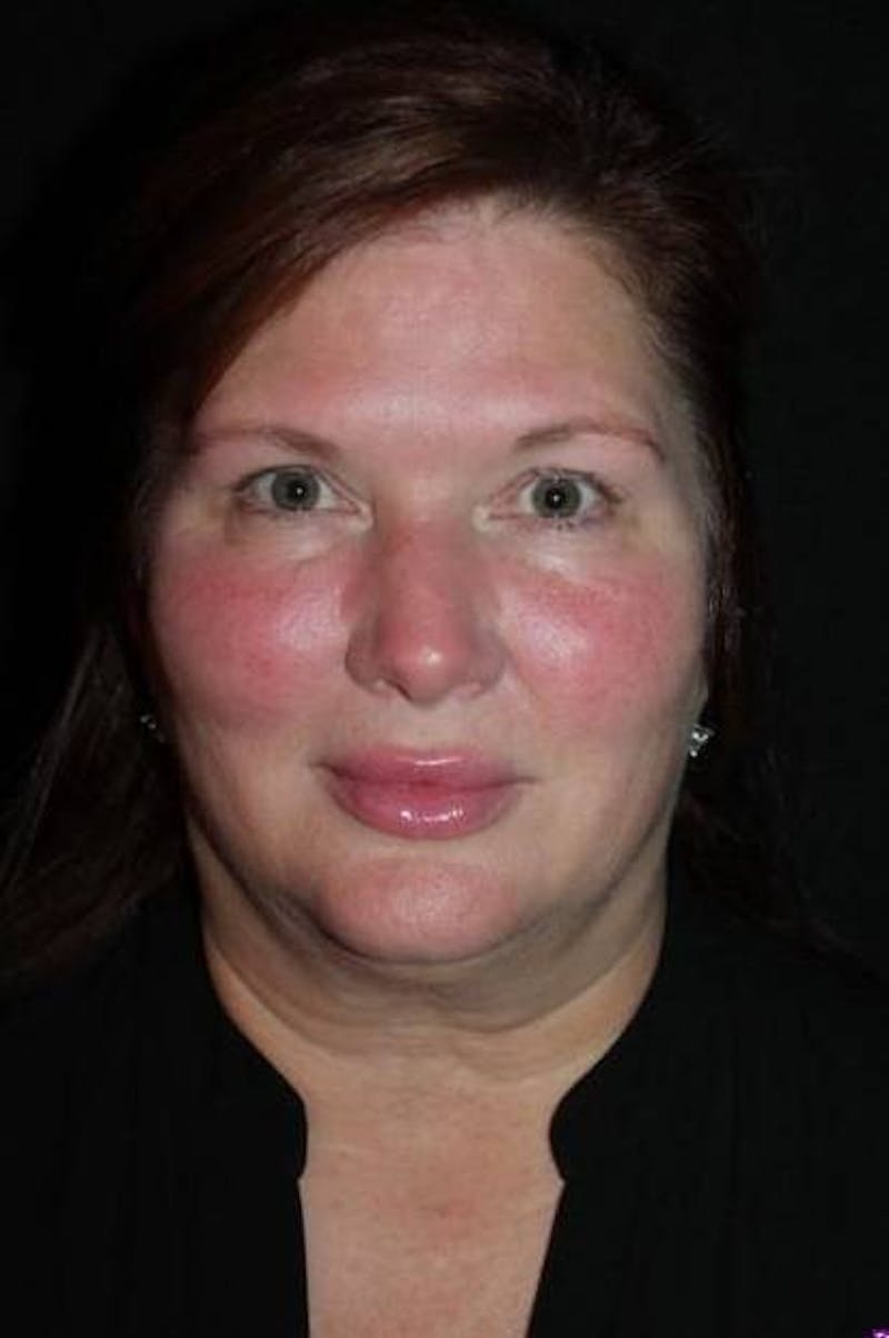 Facelift Before & After Gallery - Patient 165652 - Image 1