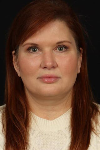 Facelift Before & After Gallery - Patient 165652 - Image 2