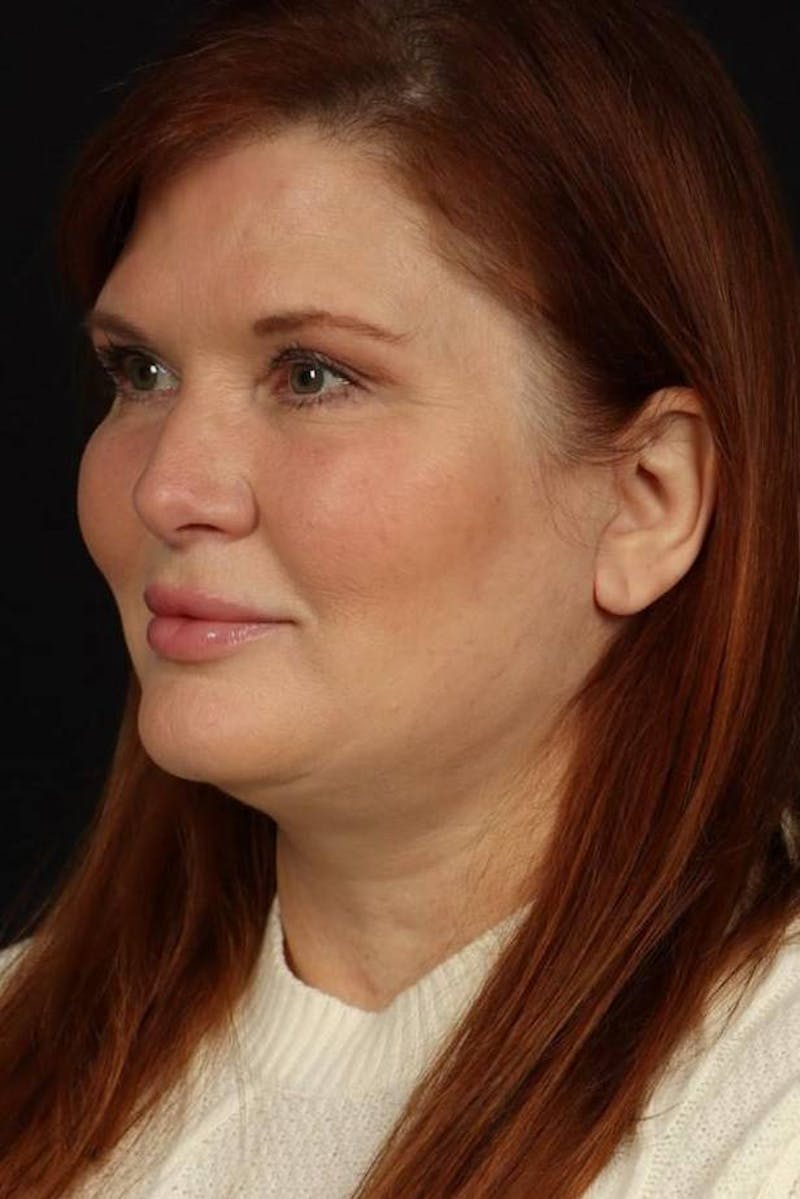 Facelift Before & After Gallery - Patient 165652 - Image 4
