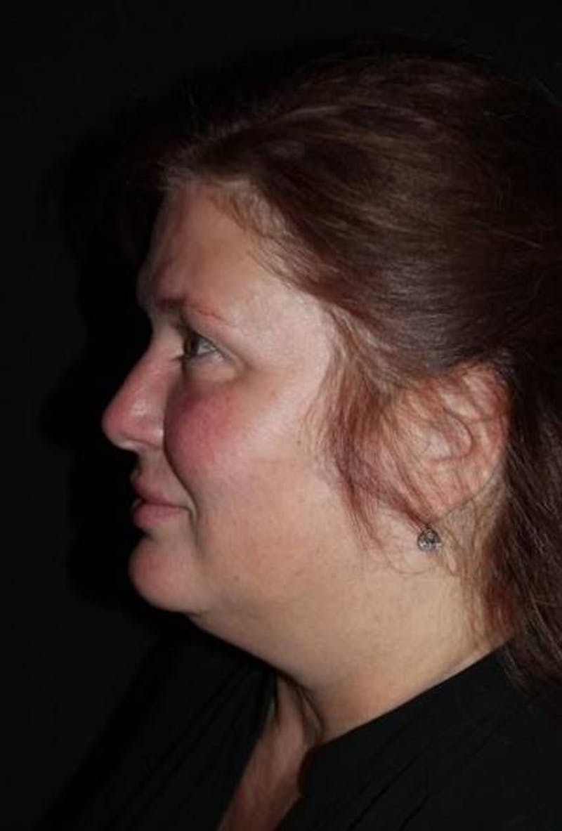 Facelift Before & After Gallery - Patient 165652 - Image 5