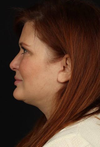 Facelift Before & After Gallery - Patient 165652 - Image 6