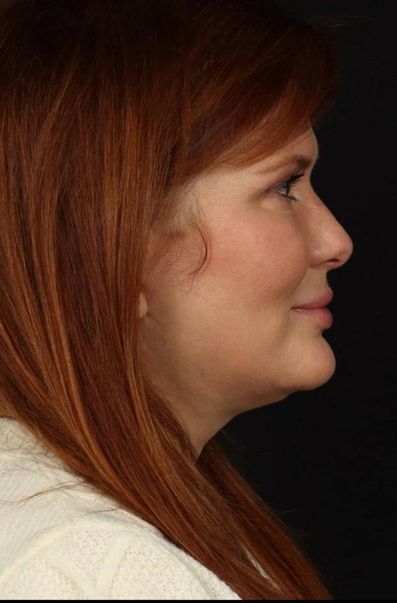 Facelift Before & After Gallery - Patient 165652 - Image 10