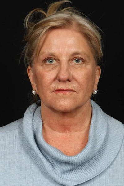 Facelift Before & After Gallery - Patient 403091 - Image 1