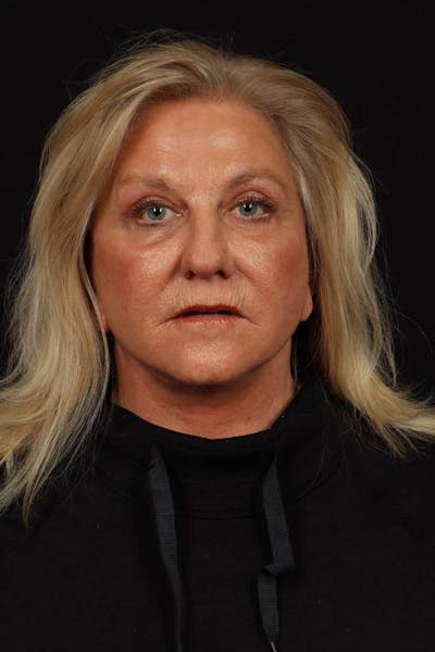Facelift Before & After Gallery - Patient 403091 - Image 2