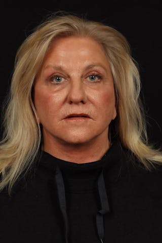 Facelift Before & After Gallery - Patient 403091 - Image 2