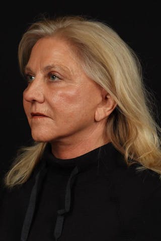 Facelift Before & After Gallery - Patient 403091 - Image 4