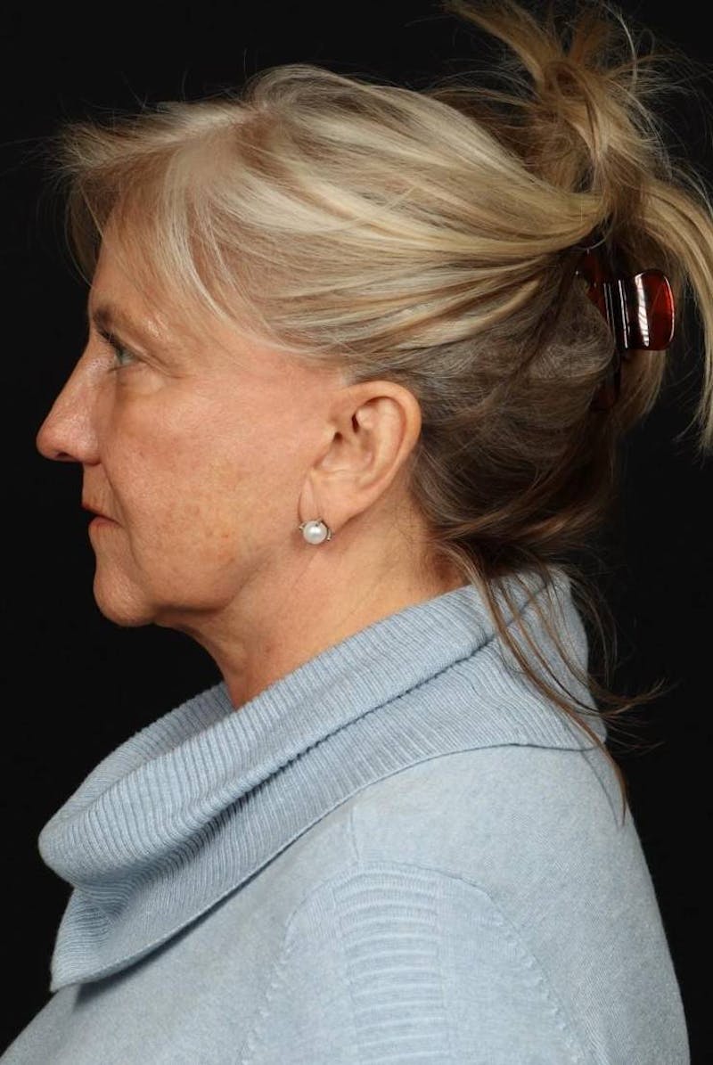 Facelift Before & After Gallery - Patient 403091 - Image 5