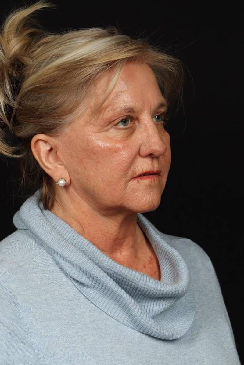 Facelift Before & After Gallery - Patient 403091 - Image 7