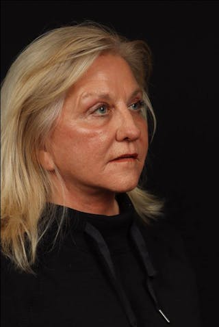 Facelift Before & After Gallery - Patient 403091 - Image 8