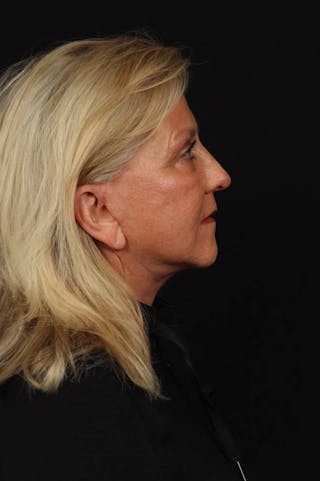 Facelift Before & After Gallery - Patient 403091 - Image 10