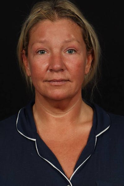 Facelift Before & After Gallery - Patient 413878 - Image 1