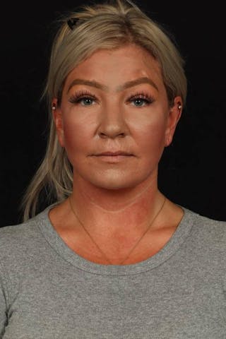 Facelift Before & After Gallery - Patient 413878 - Image 2