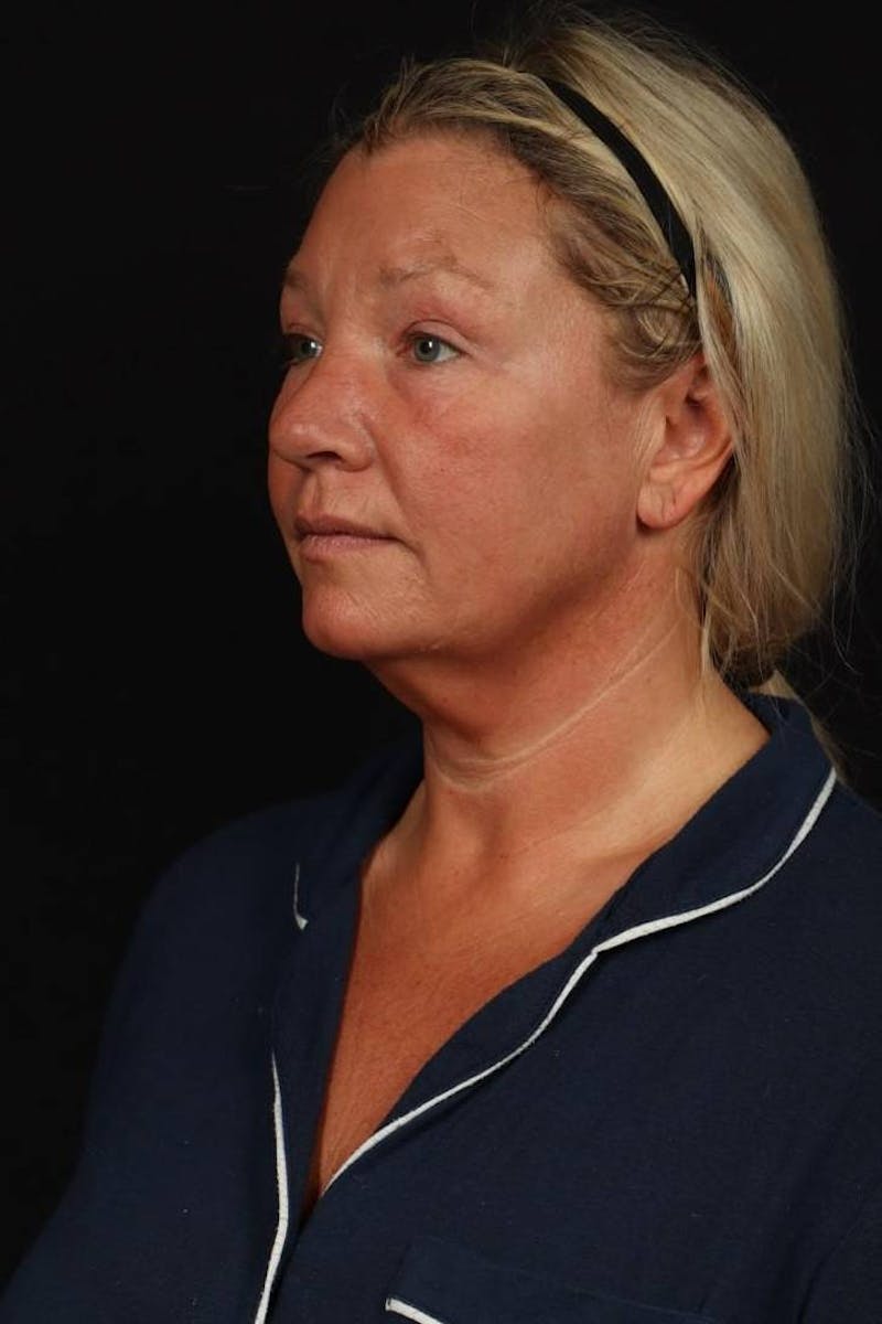 Facelift Before & After Gallery - Patient 413878 - Image 3