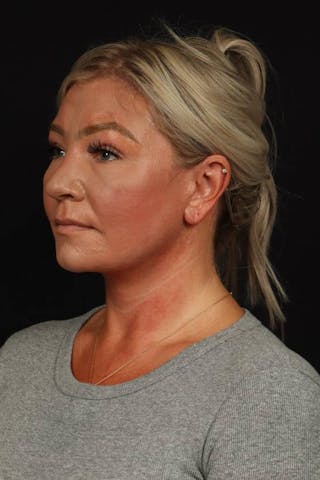 Facelift Before & After Gallery - Patient 413878 - Image 4