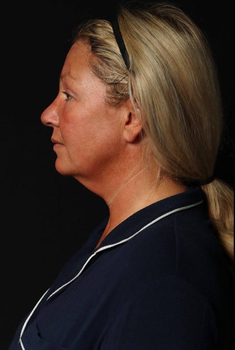 Facelift Before & After Gallery - Patient 413878 - Image 5