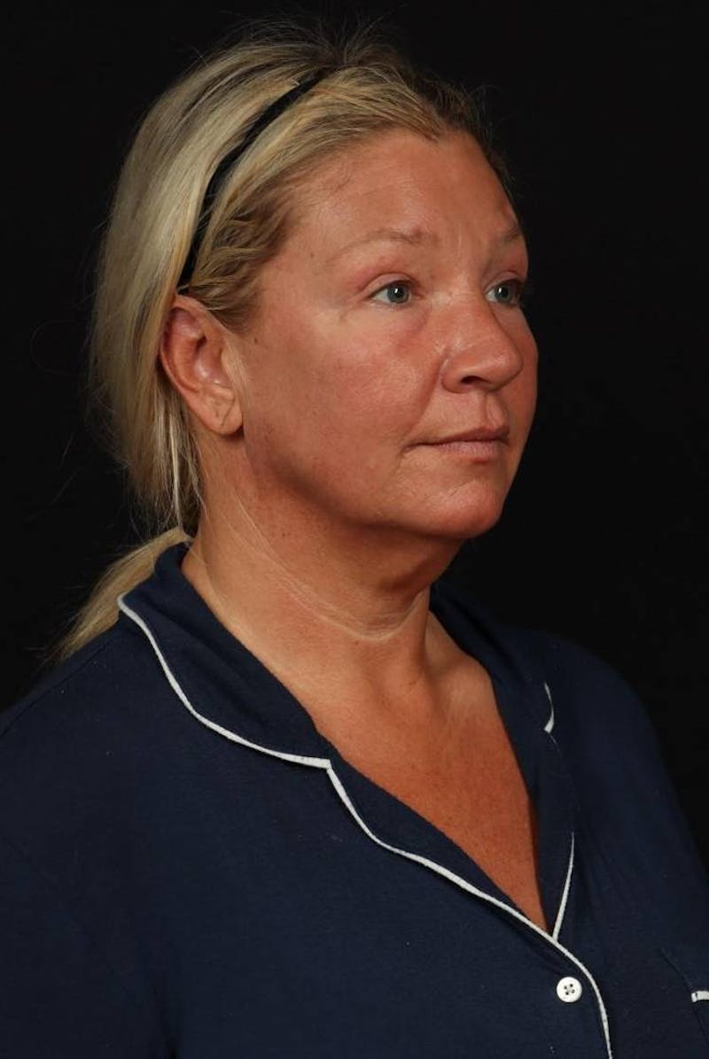 Facelift Before & After Gallery - Patient 413878 - Image 7