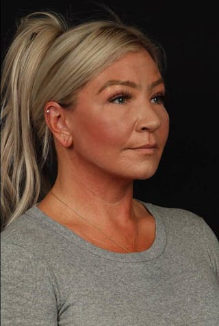 Facelift Before & After Gallery - Patient 413878 - Image 8