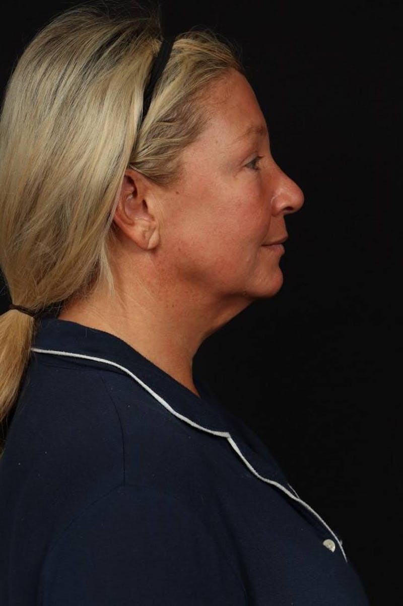 Facelift Before & After Gallery - Patient 413878 - Image 9