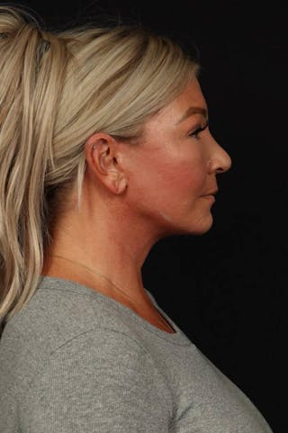 Facelift Before & After Gallery - Patient 413878 - Image 10