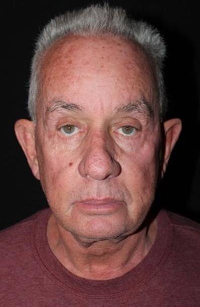 Facelift Before & After Gallery - Patient 301460 - Image 1