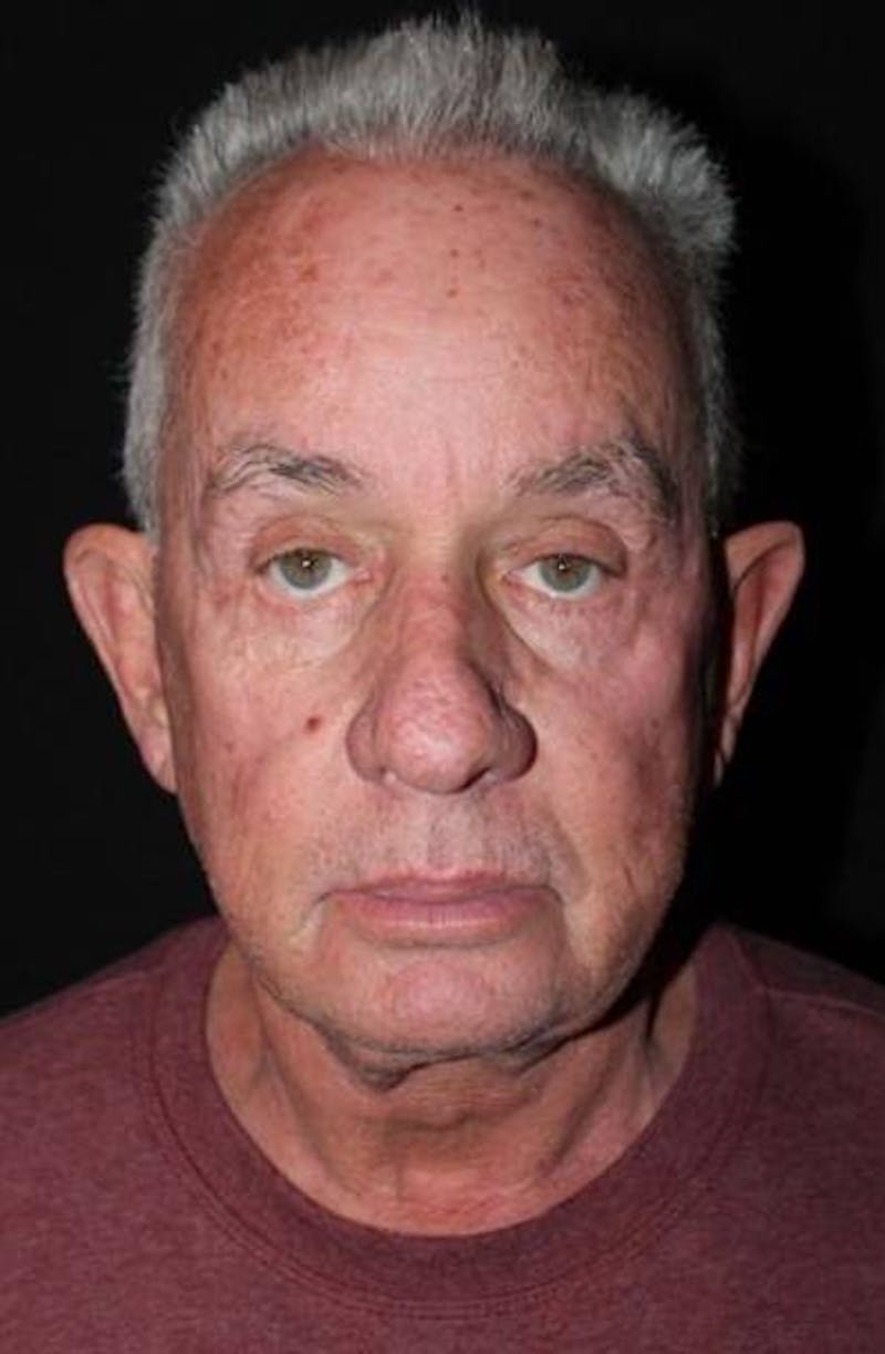 Facelift Before & After Gallery - Patient 301460 - Image 1