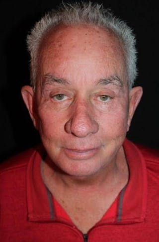 Facelift Before & After Gallery - Patient 301460 - Image 2