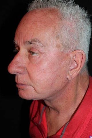 Facelift Before & After Gallery - Patient 301460 - Image 4