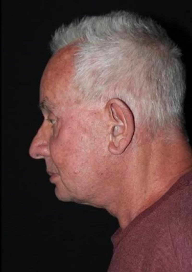 Facelift Before & After Gallery - Patient 301460 - Image 5