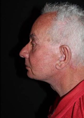 Facelift Before & After Gallery - Patient 301460 - Image 6