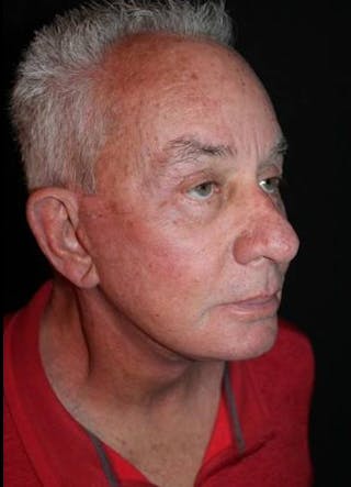 Facelift Before & After Gallery - Patient 301460 - Image 8