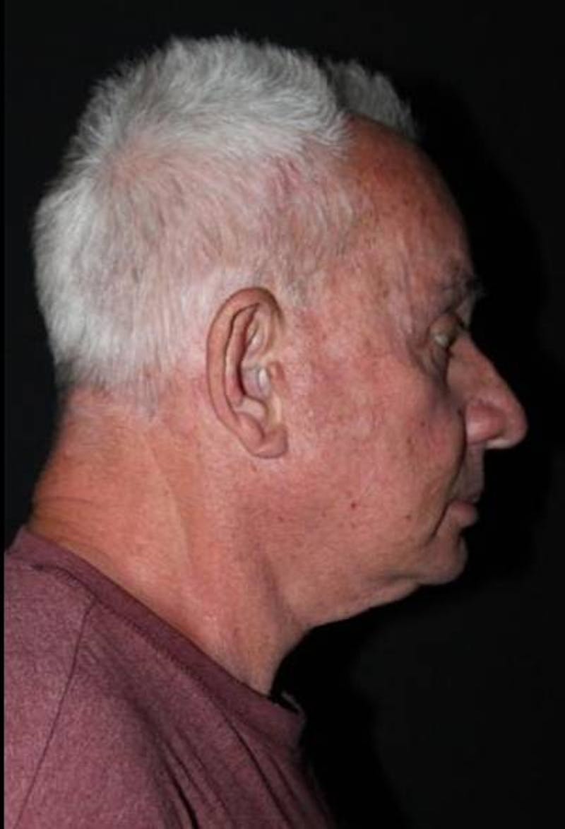 Facelift Before & After Gallery - Patient 301460 - Image 9