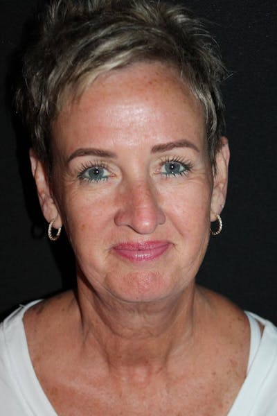 Facelift Before & After Gallery - Patient 865014 - Image 1