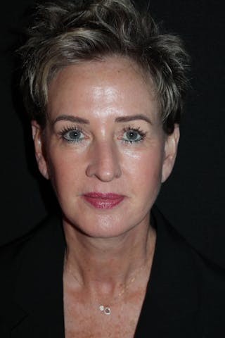 Facelift Before & After Gallery - Patient 865014 - Image 2