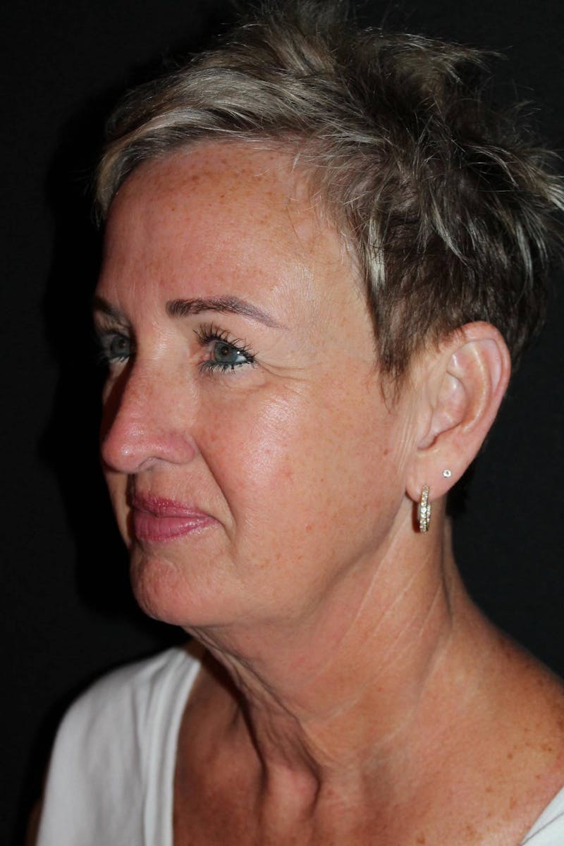 Facelift Before & After Gallery - Patient 865014 - Image 3