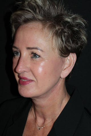 Facelift Before & After Gallery - Patient 865014 - Image 4