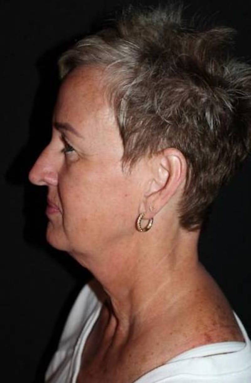 Facelift Before & After Gallery - Patient 865014 - Image 5