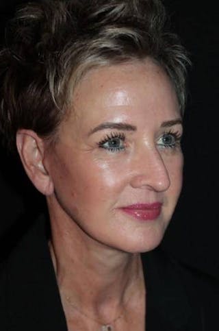 Facelift Before & After Gallery - Patient 865014 - Image 8