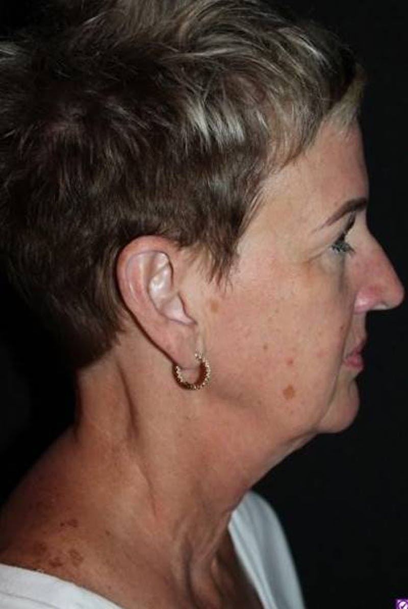 Facelift Before & After Gallery - Patient 865014 - Image 9