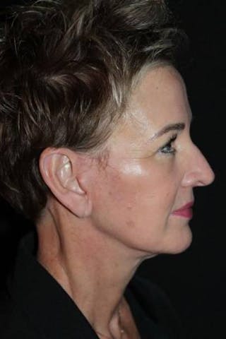 Facelift Before & After Gallery - Patient 865014 - Image 10